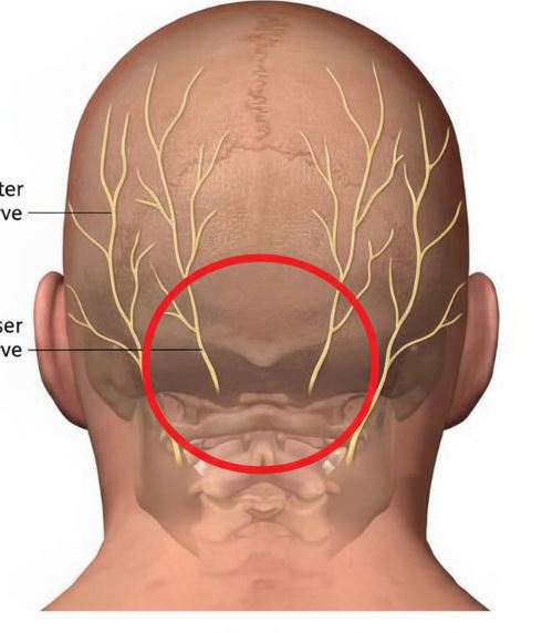 Anatomical illustration showing the suboccipital region and occipital nerves