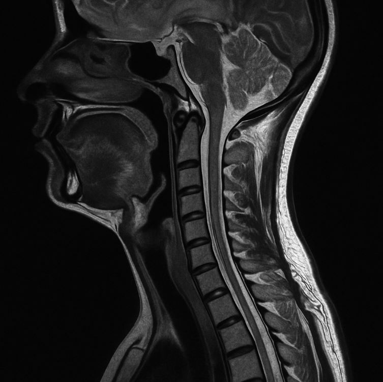 MRI scan of the head and neck
